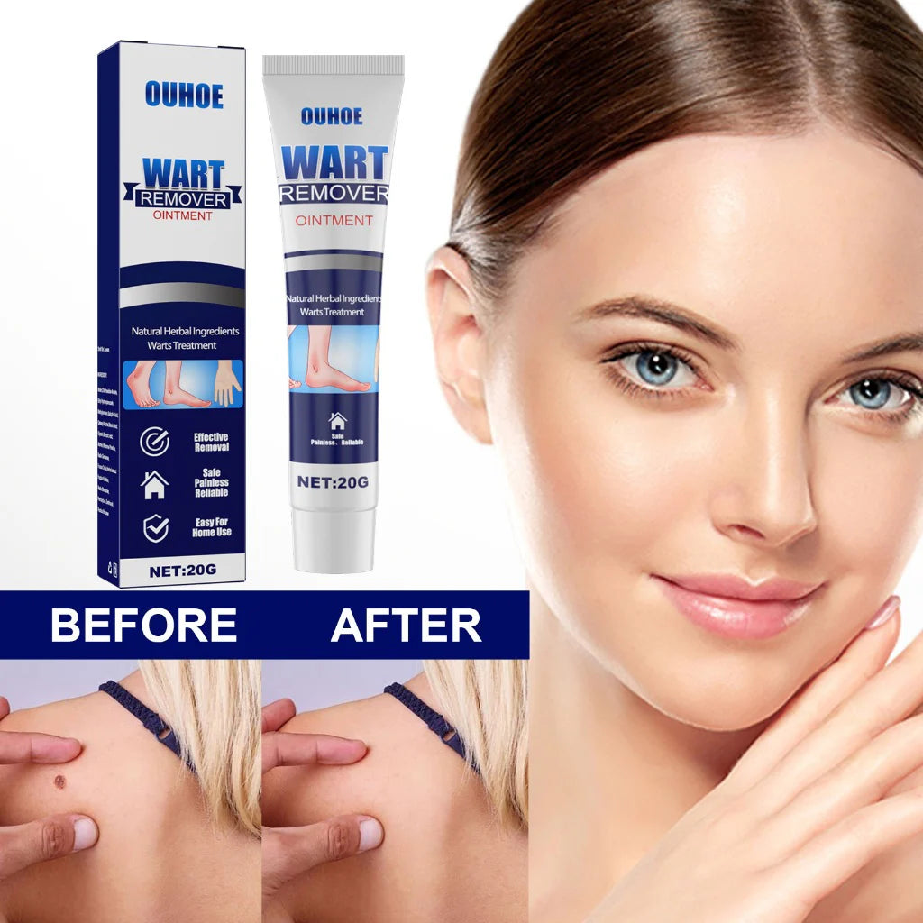 Pimple &. Wart removing ointment